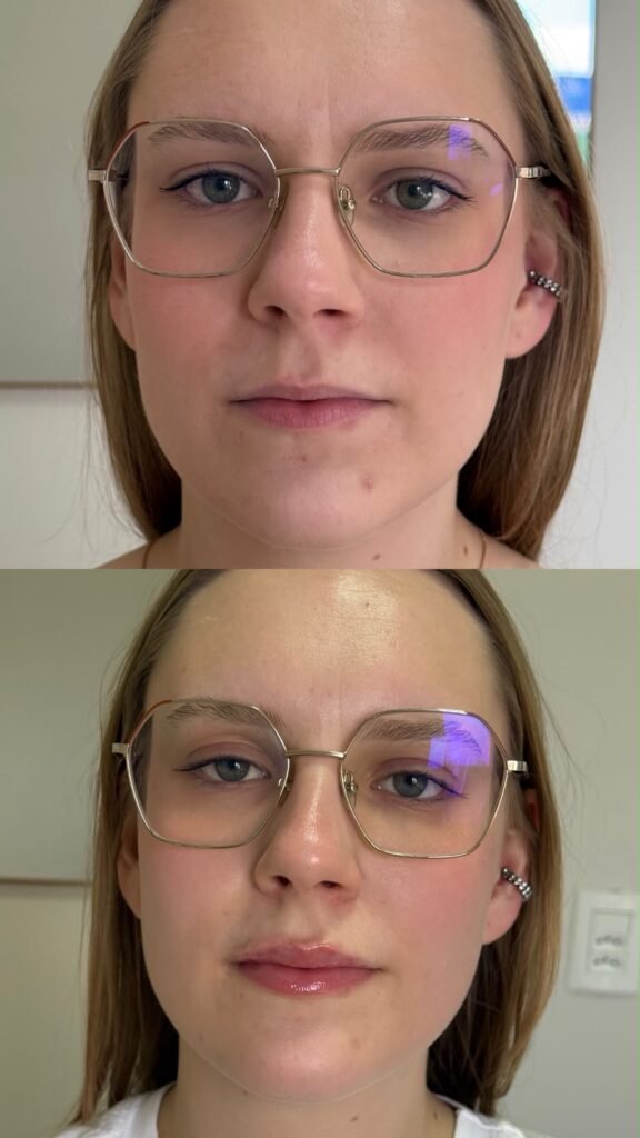 Antes e depois · Lábios