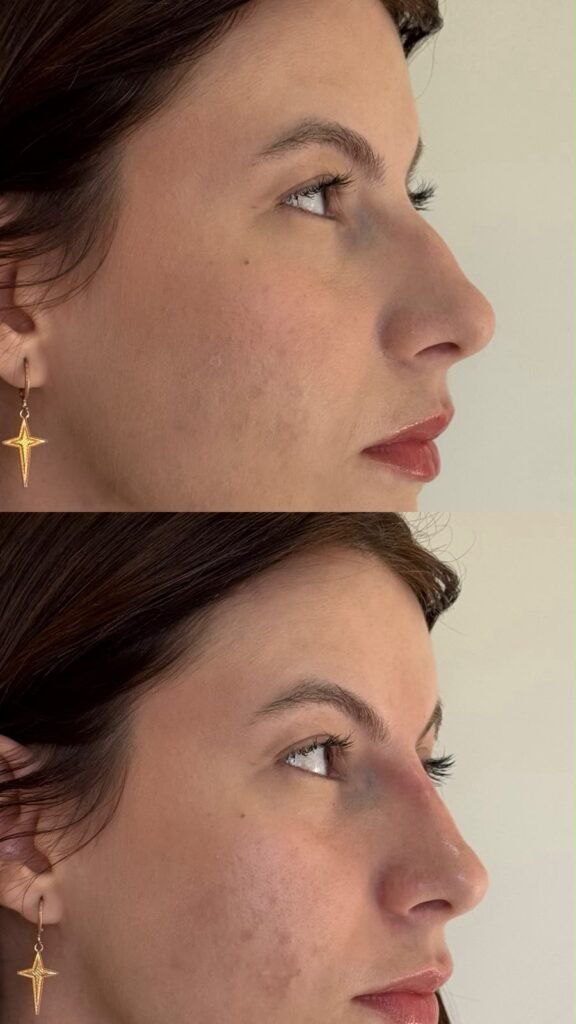 Antes e depois · Nariz & Perfil
