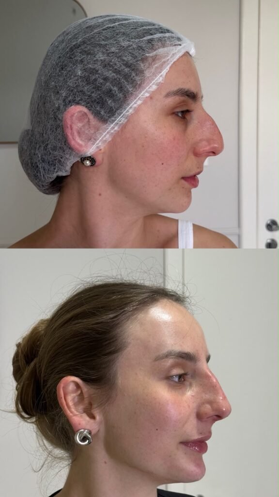 Antes e depois · Nariz & Perfil