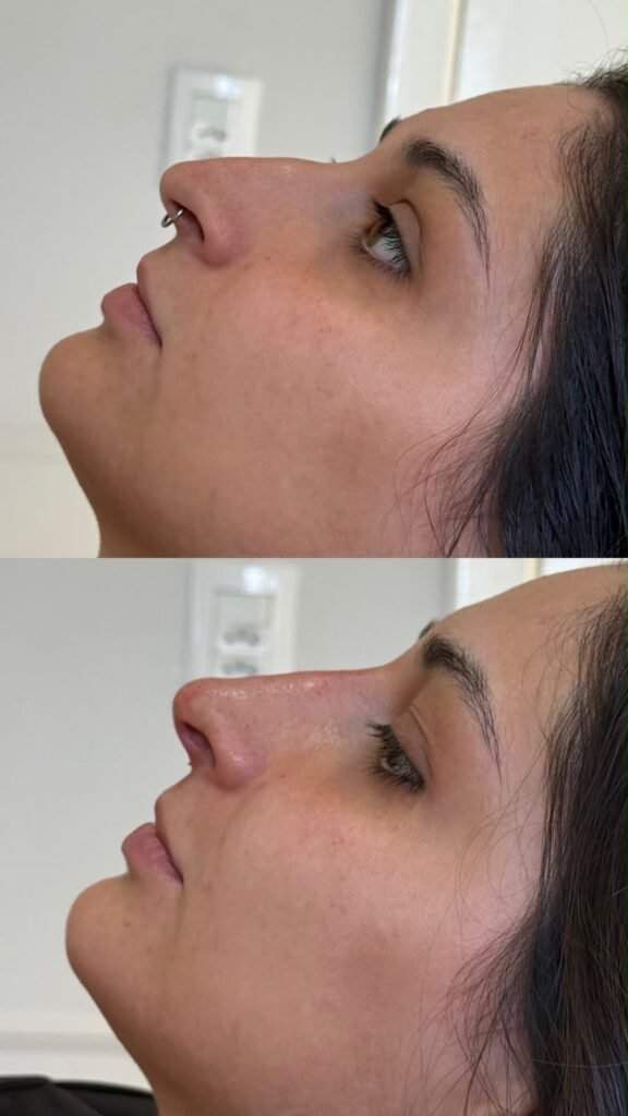 Antes e depois · Nariz & Perfil