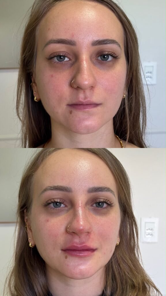 Antes e depois · Lábios