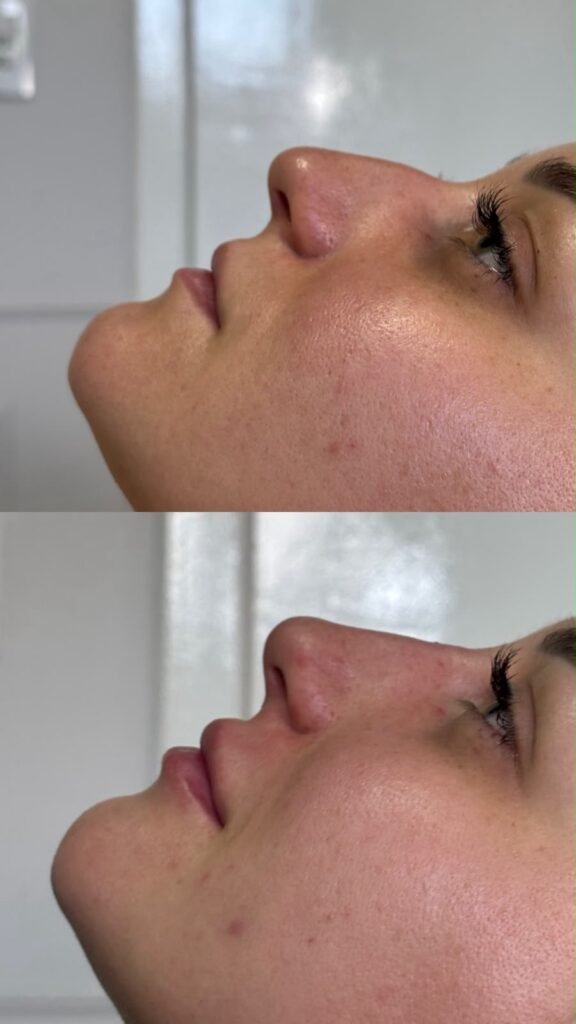Antes e depois · Nariz & Perfil