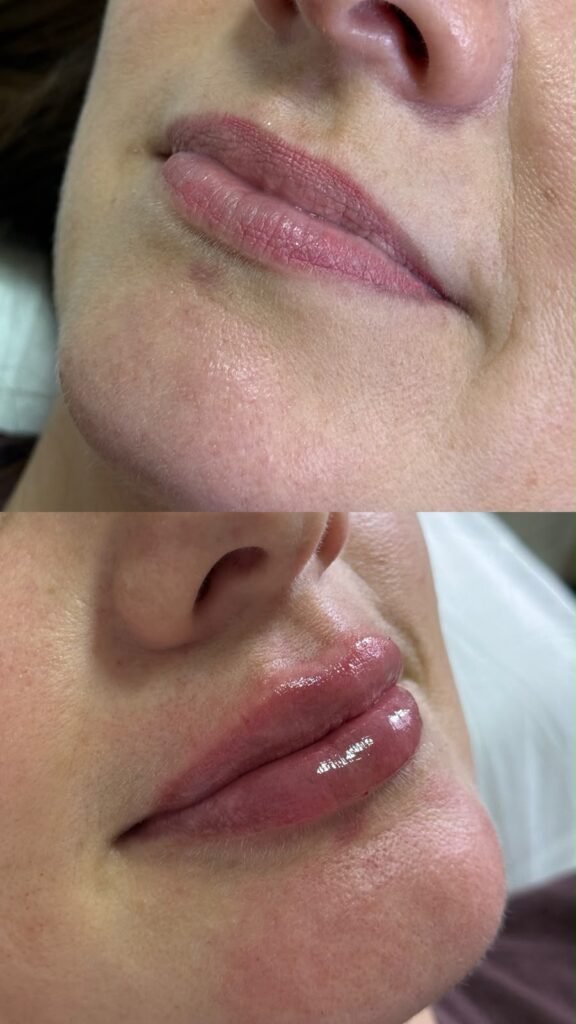 Preenchimento Labial