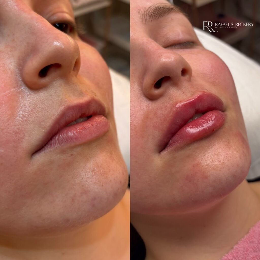 Antes e depois · Lábios
