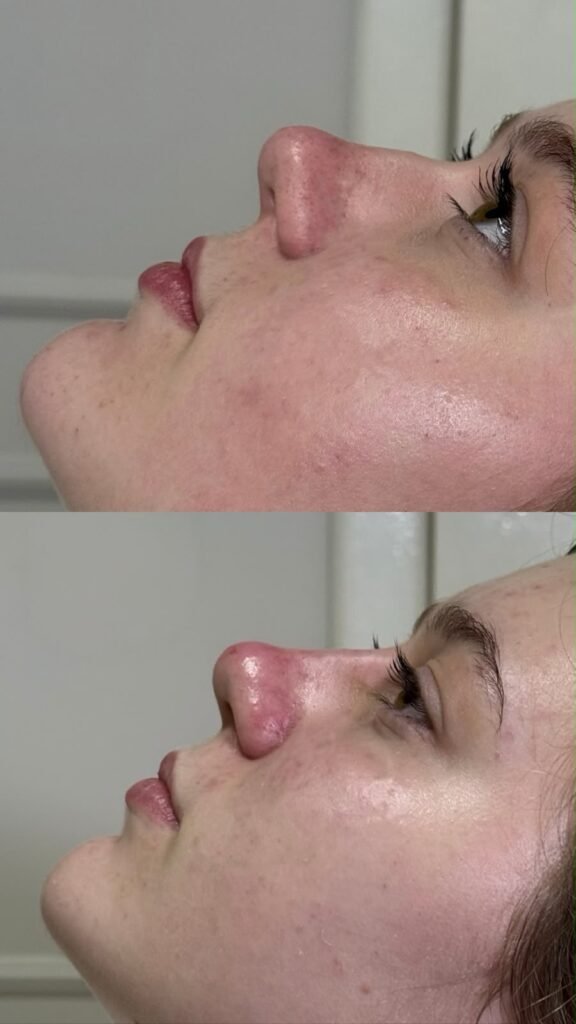 Perfiloplastia