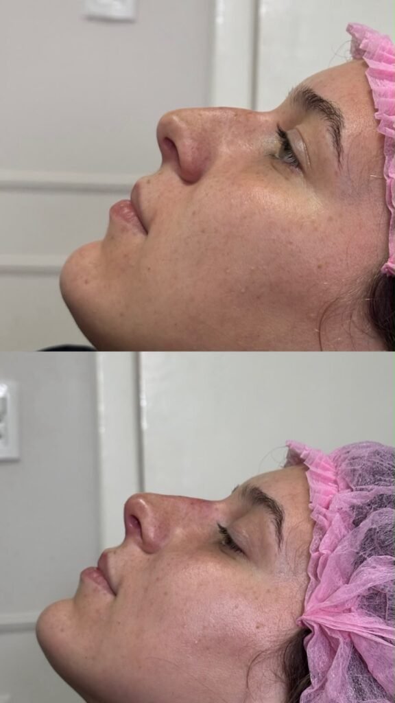 Antes e depois · Nariz & Perfil